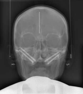 img-zygoma-implantate